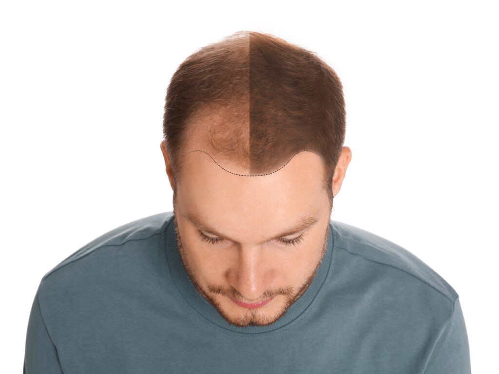 Man,With,Hair,Loss,Problem,Before,And,After,Treatment,On