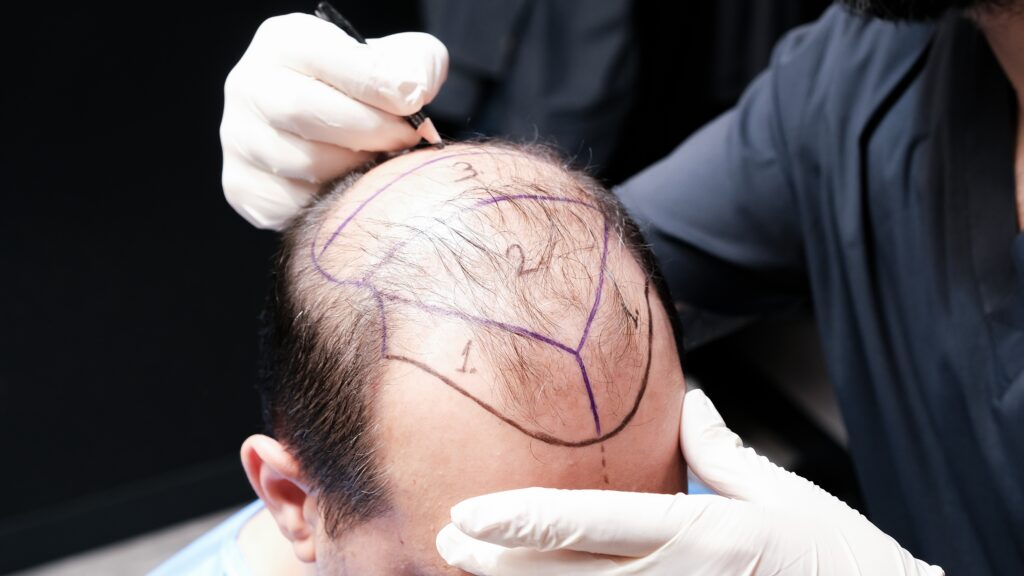 The Doctor Is Planning And Marking The Patient's Hairline Before